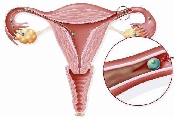 輸卵管不通,重慶送子鳥醫院